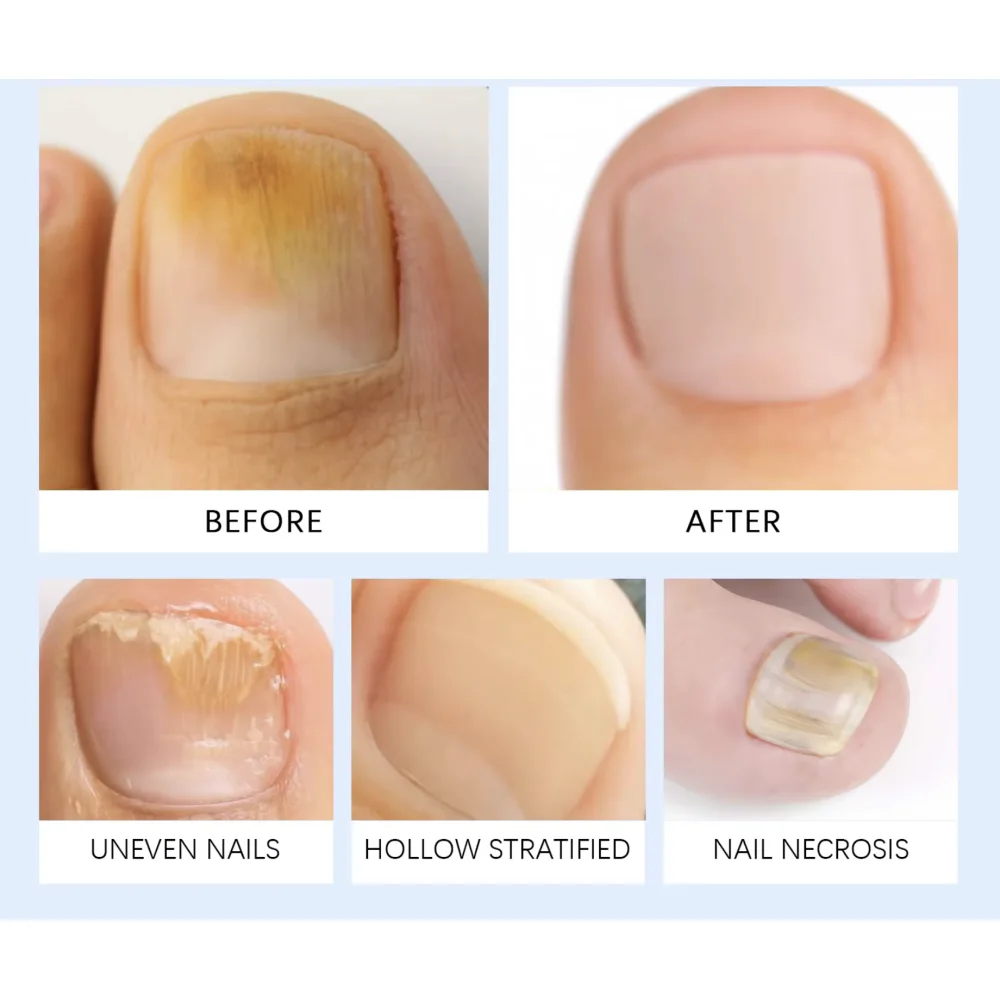 Bálsamo Anti-Fungos para Unhas