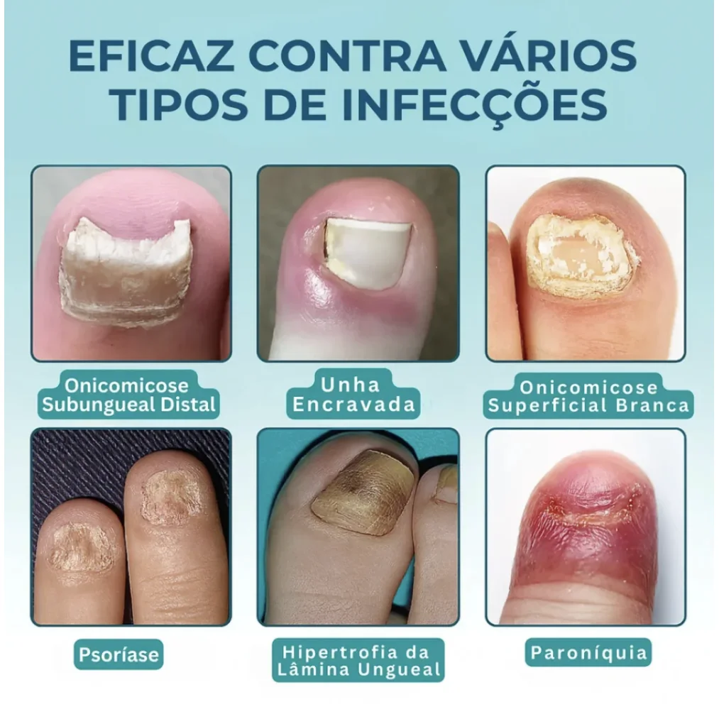 Bálsamo anti-fungos para unhas 3