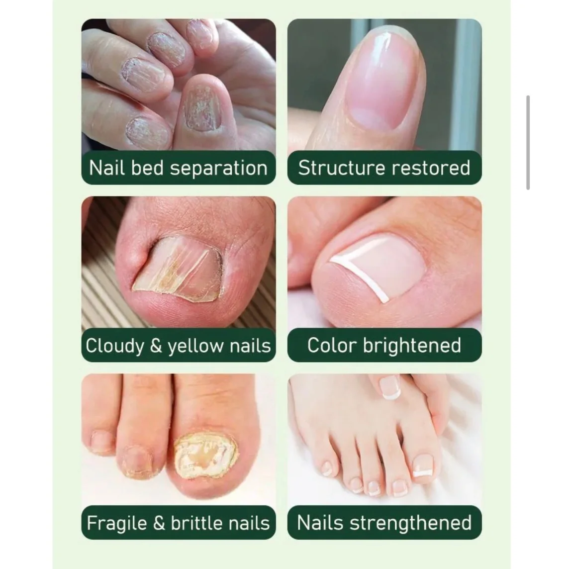 Bálsamo anti-fungos para unhas 5