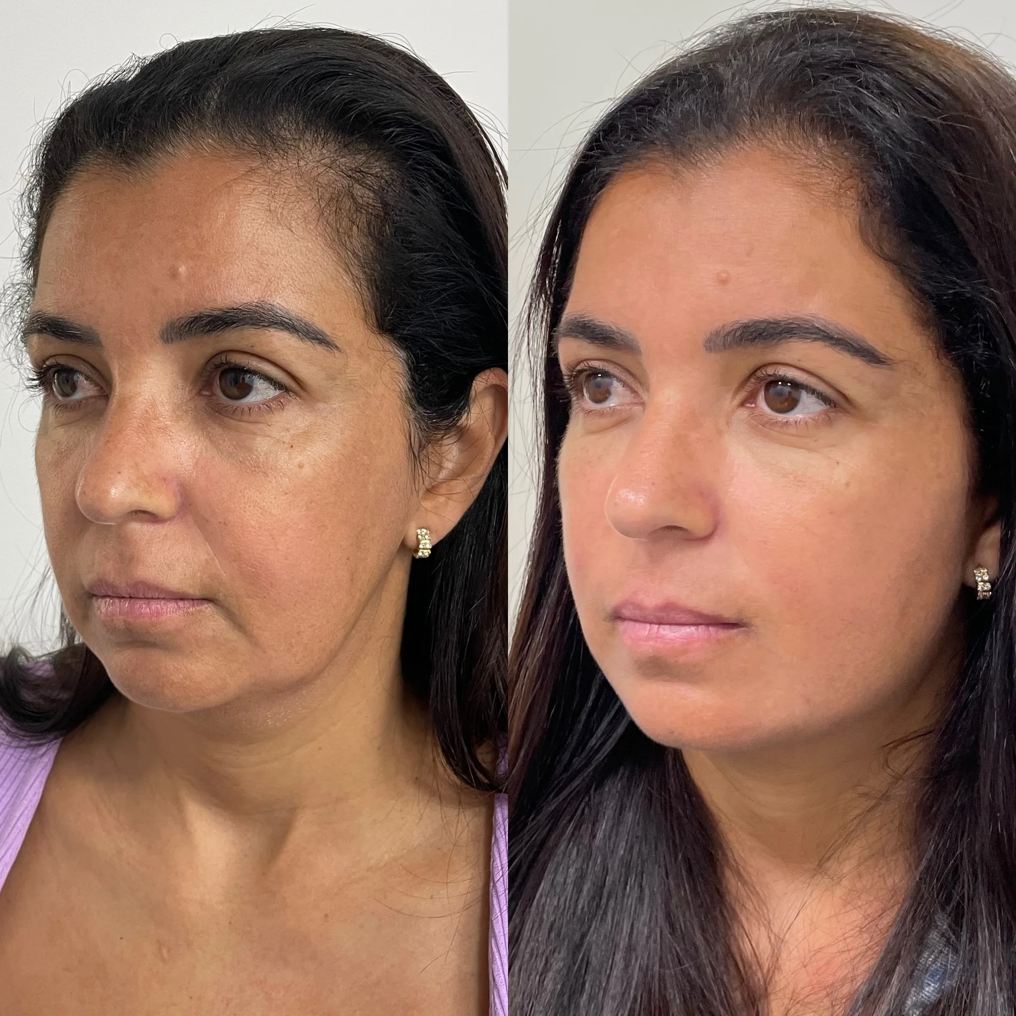 Comparação da aparência do rosto antes e depois do cuidado facial