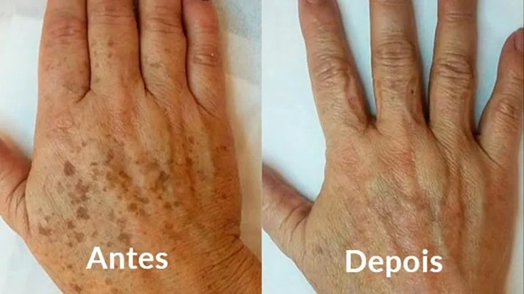 Removedor de manchas