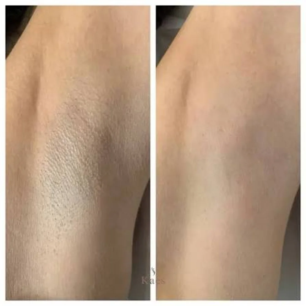 Spray Depilatório Mousse Sem Dor - Óleo de Coco e Aloe Vera 150ml